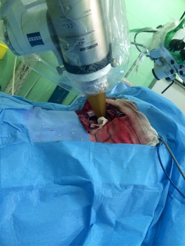 The IORT Applicator Adjusted Into the Tumor Bed