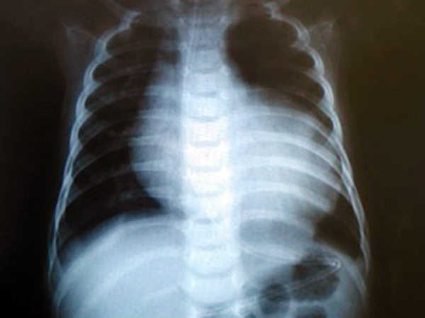 Chest X-ray shows cardiomegaly