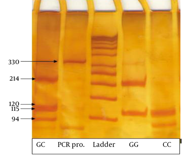 Lane 1 shows four fragments of 214, 120, 115 and 94 bp for the CG genotype; Lane 2 is PCR product (329 bp); Lane 3 is 50 bp ladder; Lane 4 is GG genotype without SNP; Lane 5 is CC homozygote genotype. Bp, base pair; F, forward primer; R, reverse primer.