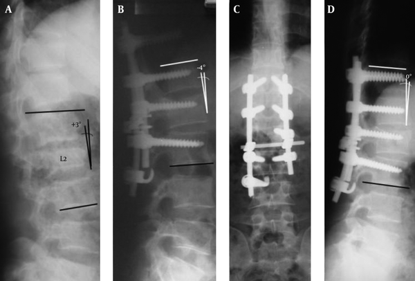 A, a 29 years old woman with L2 burst fracture, on Primary radiography; B, significant vertebral body collapse was observed due to three columns failure, significant height restoration was achieved on immediate postoperative view; C and D, remained relatively constant throughout the follow-up period of 41 months
