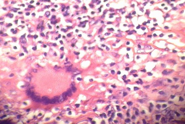 A Multinucleated Giant Cell Were Seen in Hematoxylin and Eosin Staining