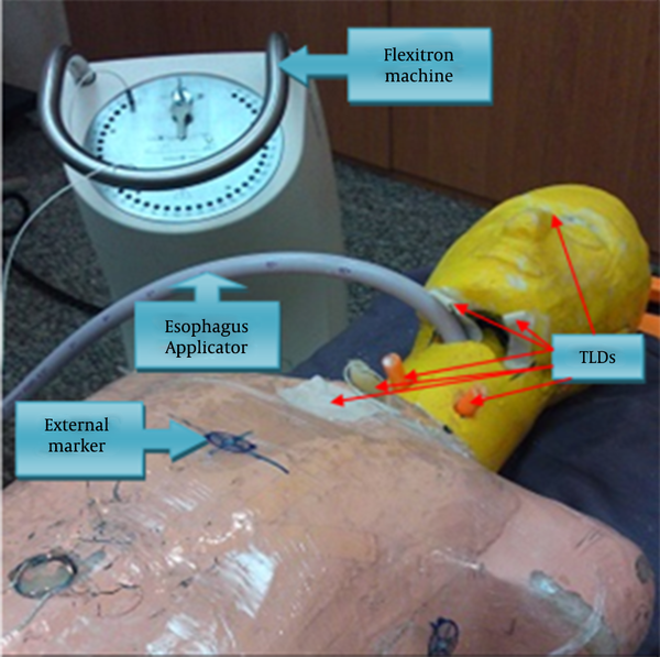 Anthropomorphic Phantom Connected to the Flexitron High-Dose-Rate Machine With Esophagus Applicator and Thermoluminescence Dosimeters Placed in Arbitrary Positions