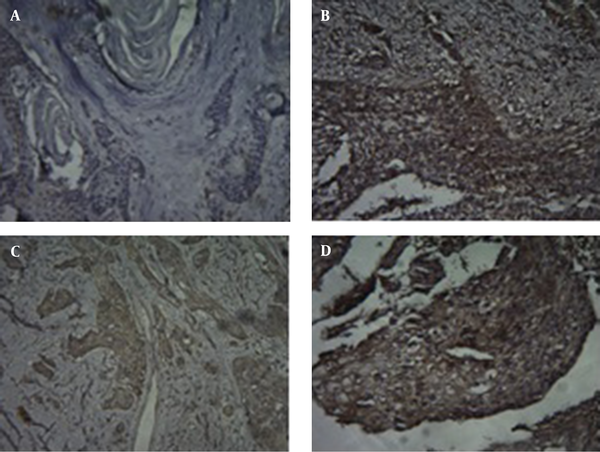 (a) esophageal squamous cell carcinoma (ESCC) specimen with HER2/neu IHC score of 0, (b) esophageal squamous cell carcinoma showing HER2/neu IHC1+ score (c), ESCC demonstrating HER2/neu IHC 2+ score (d), ESCC specimen with HER2/neu IHC score of 3. (Magnification × 100).