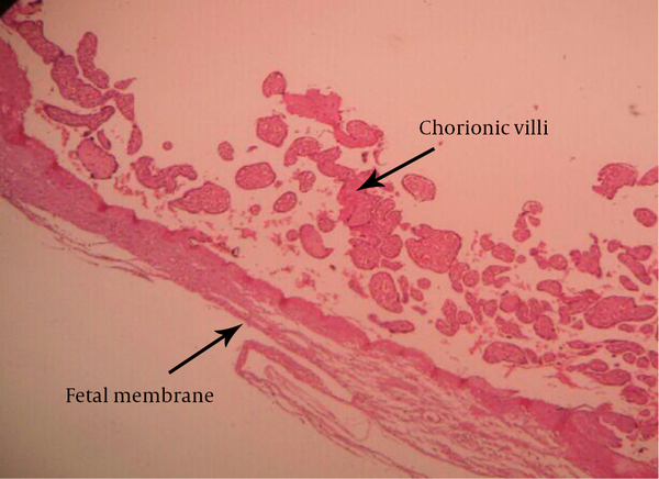 Histologic Appearance of Chorionic Villi Attached to Fetal Membrane Indicating Placental Membranacea