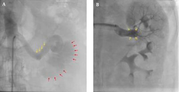 A, Digital subtraction angiography of left renal artery shows a large left renal AVF with early opacification of the dilated renal vein and weak parenchymal opacification; Renal artery (yellow arrows); renal vein (red arrows); B, Digital subtraction angiography after coil embolization shows a VSD coil in the entry of the AVF (yellow arrows); There is no blood flow via the previous fistula; The renal parenchymal opacification is increased.
