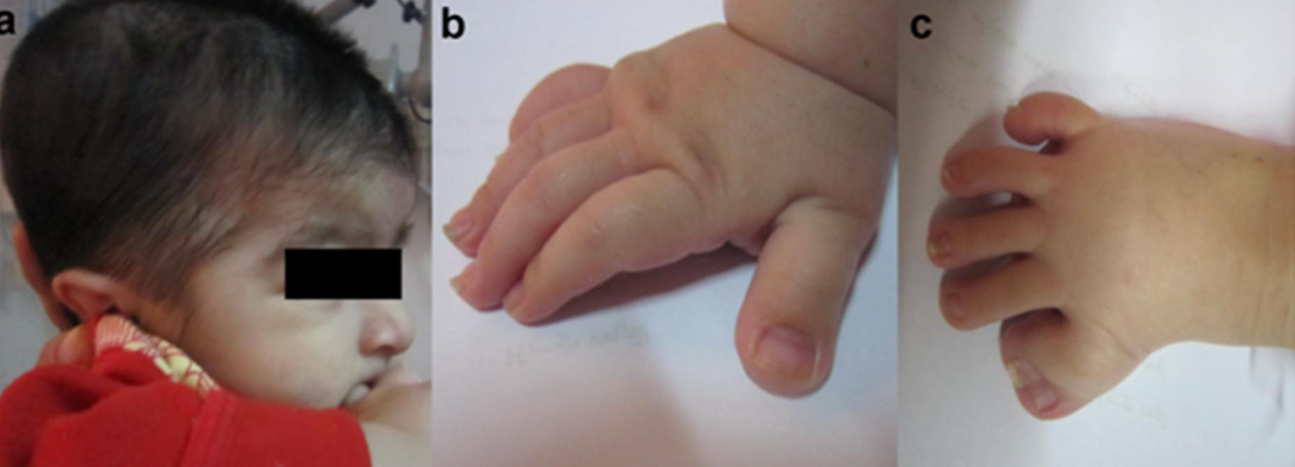 Facial features of Rubinstein-Taybi syndrome