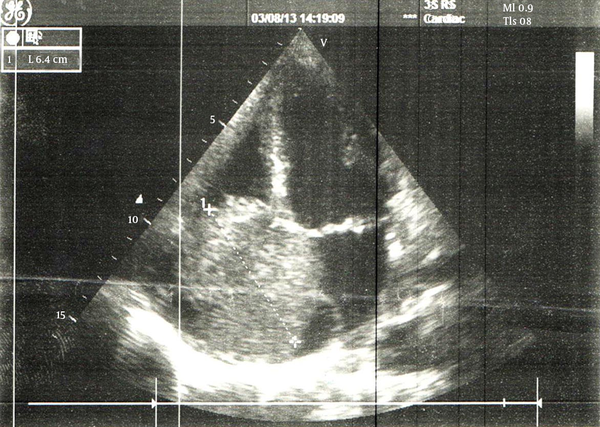 Right Atrial Mass on Echocardiography