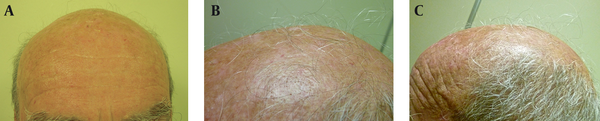 A, Patient’s scalp with very few hairs, prior to the treatment; B, Detail of the regrown hair after six months of treatment; C, Several pigmented and white terminal hair growth.