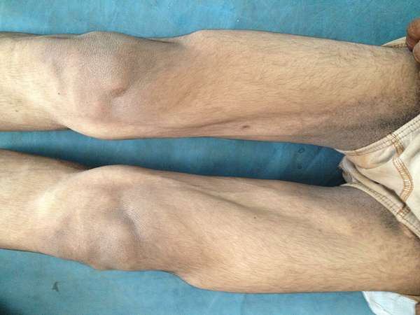 Lipoatrophy of Lower Limbs With Prominent Veins