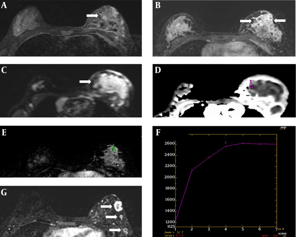  Breast MRI. A, Axial STIR image showing a heterogeneous mass (white arrow); B, Axial image of early subtraction dynamic MR showing an ill-defined heterogeneously enhancing mass (white arrows); C, Axial DWI MRI showing hyperintense signal (white arrow); D, Axial section of the ADC map showing an ROI cursor (purple circle) placed over a hypointense area within the tumor (black arrow); the area calculated for the tumor had an ADC value of 0.25 × 10-3 mm2/s at a b-value of 1000 mm2/s; E, Dynamic curve with ROI (green circle) placed over the enhancing solid tissue; F, Dynamic curve shows a plateau (type II) curve. The curve reaches a peak during the arterial phase 180–240 seconds after contrast medium injection, followed by a flattening during the delayed phase; G, Axial image of early subtraction dynamic MR post-chemotherapy showed significantly reduced tumor size, with multiple well-circumscribed hypointense lesions demonstrating rim enhancement (white arrows).