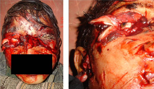 Wolf Attack of a 12-Year-Old Male Showing Extensive Lacerations of Face with Disruption of Right Eyelids and Exposure of Nasal Bone