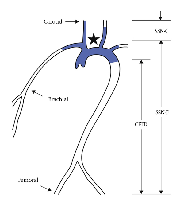SSN-C, distance from the carotid sensor to the sternal node; SSN-F:, distance from the sternal node to the femoral sensor; CFTD, SSN-F minus SSN-C.
