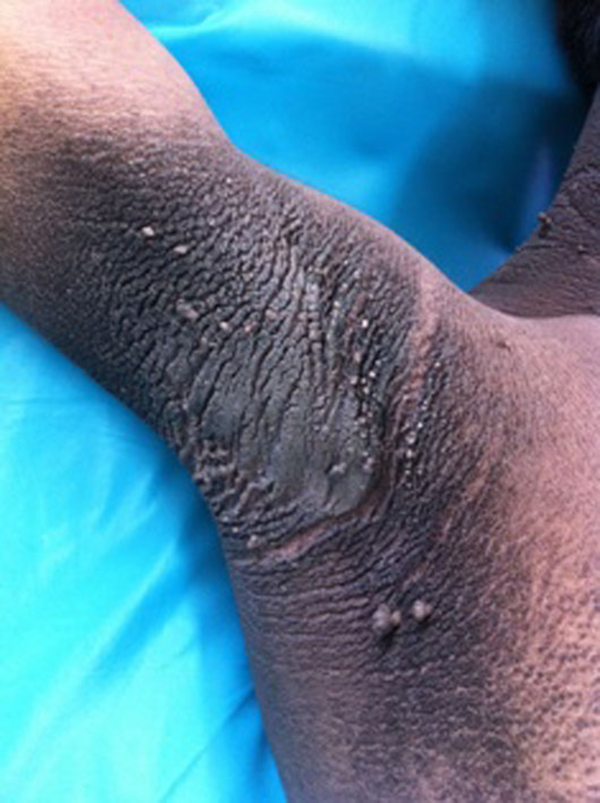 Acanthosis Nigricans With Multiple Acrochrodons in the Axilla