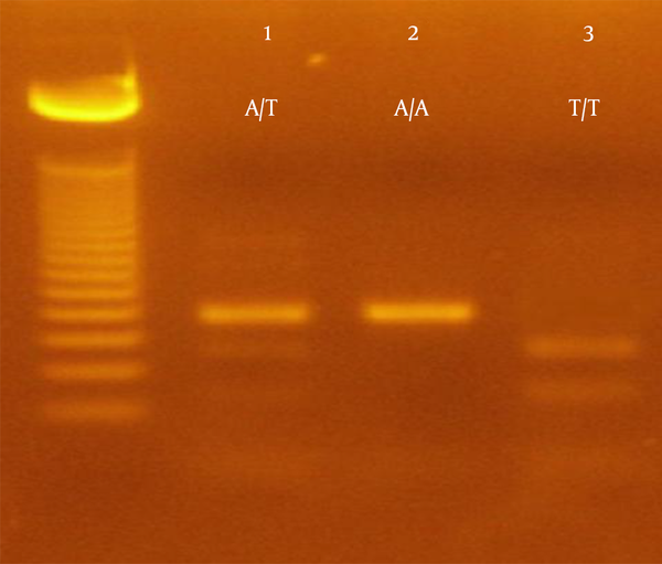 PCR product (194 bp) remains intact if A allele is present and yields two fragments (131 bp and 63 bp) in case of T allele.