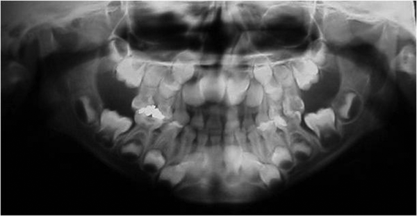 Panoramic Radiograph Showing Deep Carious Lesion in the Lower Left Second Primary Molar