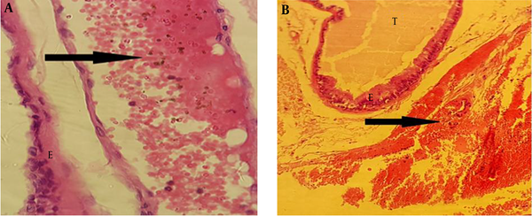 A and B: The Cross Section of the Prostate Tissue in the Treatead Group, with BPA at 100 µg/kg, Revealed Congestion (Arrows), Epithelium (E), and Secretory Units (T)