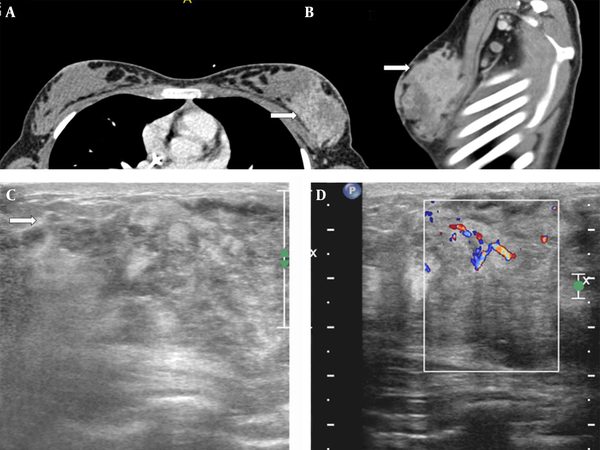 A 13-year-old girl with history of embryonal rhabdomyosarcoma of the maxillary sinus presented with a rapidly growing painless mass in left breast. A, Contrast-enhanced CT of the chest (white arrow) shows a large heterogeneously enhancing mass occupying the outer half of the left breast on axial (white arrow) and B, sagittal (white arrow) images; C, Ultrasound of the left breast shows a large heterogeneous mass with poorly defined margins (white arrow); D, Color Doppler demonstrates increased peripheral vascularity.