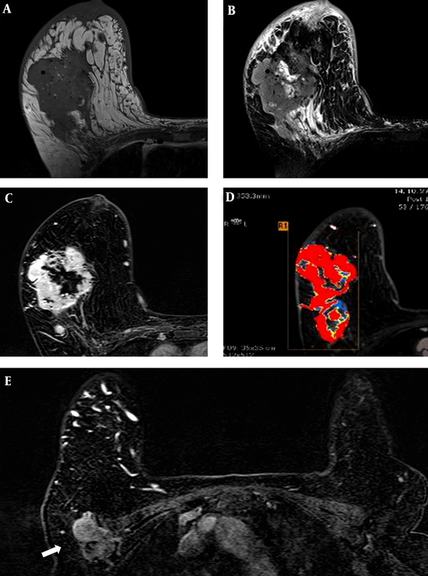 MRI of the mass. A, T1-weighted image shows intermediate signal intensity; B, Fat-saturated T2-weighted image also shows intermediate signal intensity with internal high intensity area representing the necrotic portion; C, The mass demonstrates a heterogeneous enhancing pattern with type III kinetic curve; D, Rapid enhancement and washout showing red area in the computer aided diagnosis (CAD) system; E, A 4.4 cm sized metastatic lymph node with internal necrosis in the left axillae is seen on enhanced T1-weighted image (arrow).