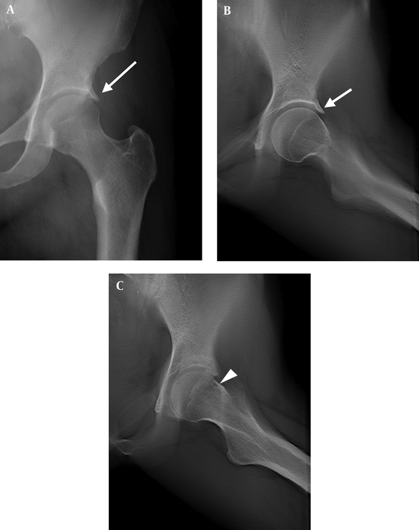 Detection Of Acetabular And Proximal Femoral Radiographic Abnormalities