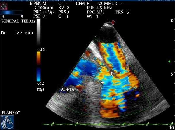 Midesophageal 5- Chamber View, Demonstrating the Left Ventricular Outflow Tract (LVOT), the Aortic Valve, and the Proximal Part of the Ascending Aorta With Color Doppler Regurgitation Through the Aortic and Mitral Valves