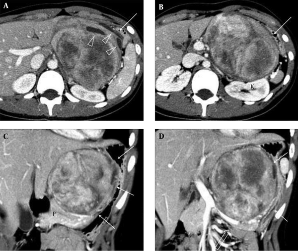 Computed tomography of the abdomen in a 16-year-old girl with dyspepsia and abdominal distension. A, B, Axial images show approximately 12 cm, large, well-defined mass in the lesser sac. The mass shows heterogeneous enhancement with some low-density areas and cystic changes (arrowheads). The mass is displacing the stomach (arrows) anterolaterally and the kidney (k) posteriorly. C, D, Coronal reformatted images show that the mass compresses the lesser curvature of the stomach (arrows) and displaces the pancreas (p) and splenic vein (open arrow) inferiorly.