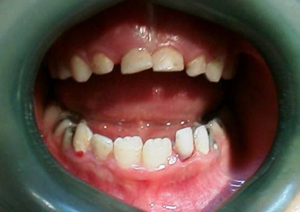 Presence of Blood Around Gingival Sulci of Lower Left Primary Lateral Incisor