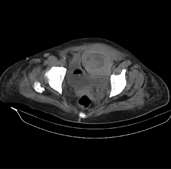 Abdominal Computerized Tomography Scan Showing Acute Chronic Abdominal Wall Hematoma