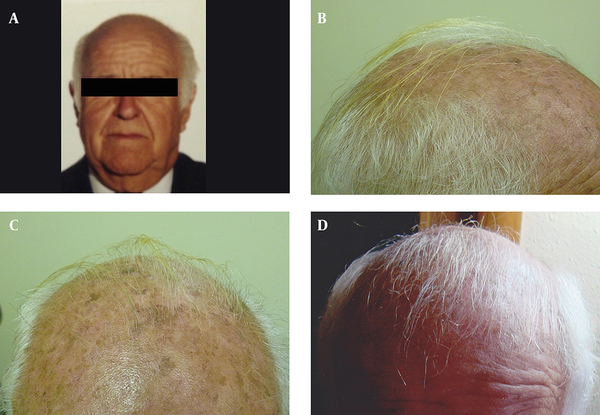 A, Photo provided by the patient, taken two years before the treatment, showing scalp with absence of hair; B and C, Evidence of terminal hair growth over non-prior haired biparietal area, after a six-month treatment with topical diclofenac 3% gel-based drug compound; D, After four years follow-up, the patient showed abundant white hair regrowth.