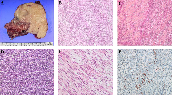 The surgical pathology. A, Macroscopically, the tumor is a whitish-gray oval, firm solid mass measuring 13 × 13 × 6 cm, the external surface of the mass is mostly smooth but focally irregular and adherent to soft tissue; B, Microscopically spindle tumor cells are arranged in intersecting fascicles with alternating densely cellular areas and less cellular areas; C, Nuclear is evident adjacent to the cellular fascicles; D, The high-power view reveals dense fascicles of spindle cells with bulky, ovoid, and irregular cellular nuclei; E, Elongated wavy-to-buckled nuclei are shown in the less cellular areas; F, Immunohistochemically, the tumor is focally positive for S-100 protein.
