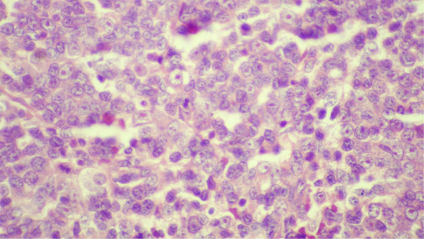 Thick Nuclear Membrane Andprominent Nucleoli in Extra Renal Rhabdoid Tumor (H and E, × 400)