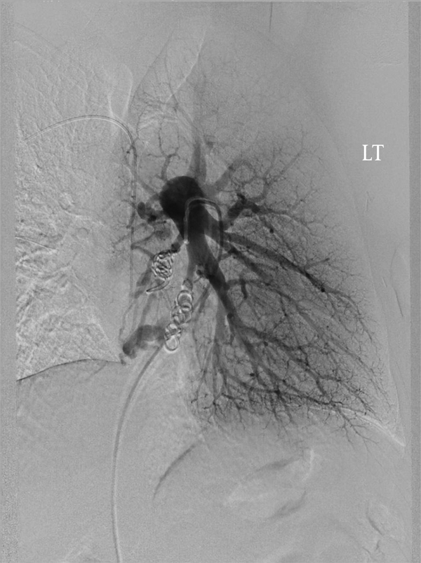 Left Lower Lobe Branches of Pulmonary Arteriogram Shows 2 Recanalized AVM Nidi Through the Previously Embolized Feeding Vessel With Microcoils