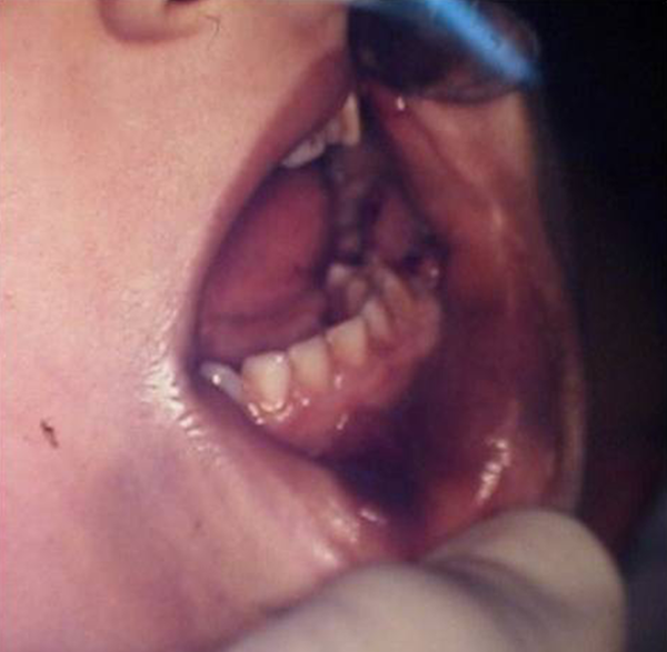 Extension Vestibule of the Left Second Primary Molar Hematoma in the Lower Lip