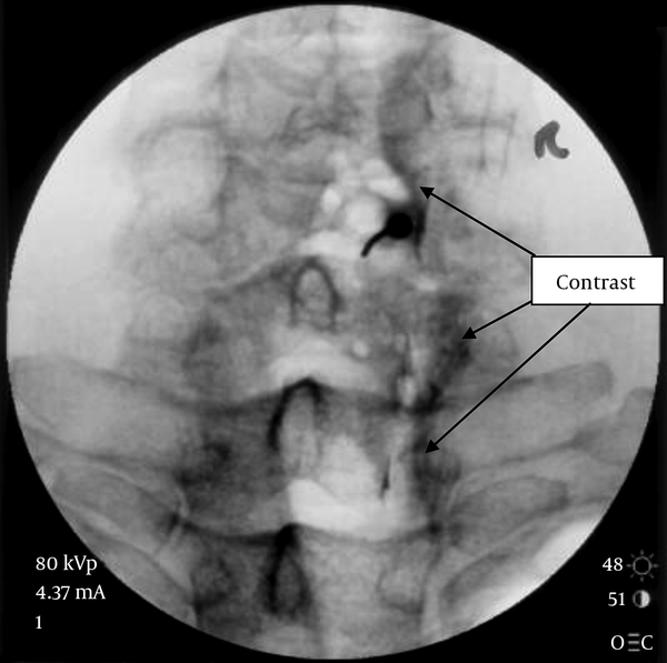 Posterolateral View of the Cervical Spine with contrast injection showing the typical Contrast Pattern for Epidural Injection with Limited Cephalocaudal Spread and Outlining of Nerve Roots