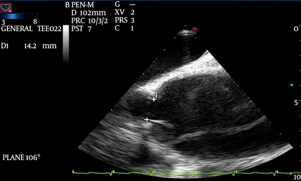 Midesophageal Long Axis (LAX) View of the Ascending Aorta With Color Doppler Demonstrating the Distances