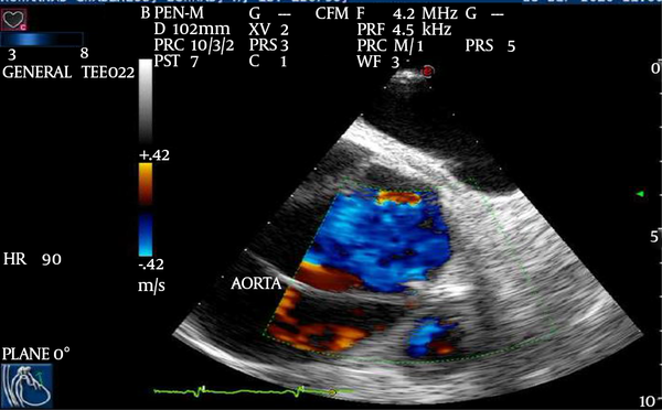 Midesophageal 5- Chamber View Focusing on the Proximal Part of the Ascending Aorta, Demonstrating the Ascending Aorta With Color Doppler Flow through the Intimal Layer