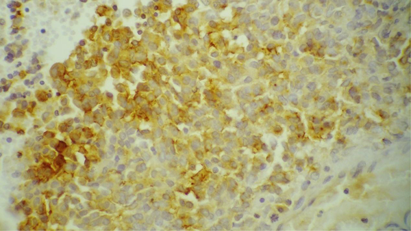 EMA Immunoreactivity in Extra Renal Rhabdoid Tumor (EMA IHC, × 400)