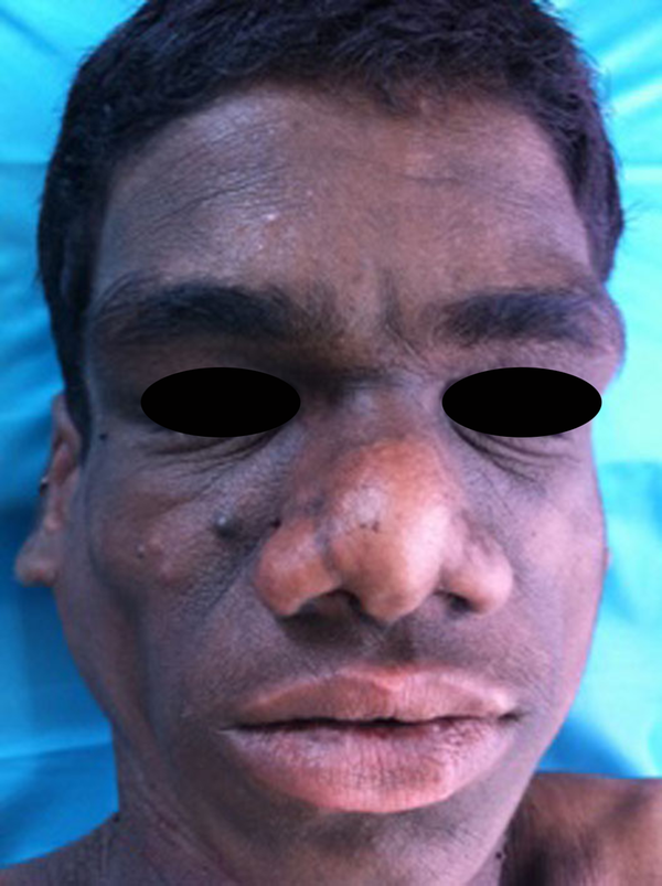 Acromegaloid Features With Prominent Orbital Ridges and Prognathism