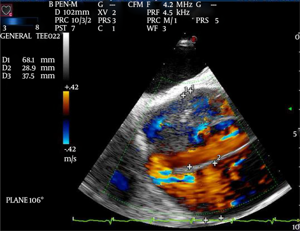 Midesophageal Long Axis (LAX) View of the Ascending Aorta With Color Doppler Demonstrating Flow Through the Intimal Layer