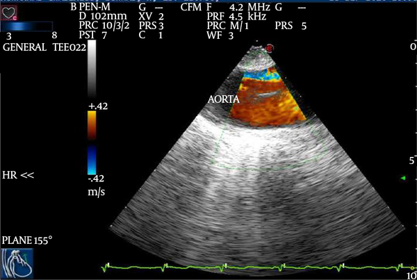 Upper Esophageal Short Axis View, Demonstrating the Aortic Arch With Color Doppler and the Aortic Flap