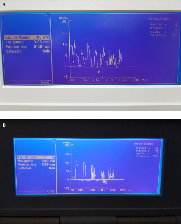In a patient of the sample, at initial evaluation (A), maximal and mean strenght was 18 and 5 mmHg, respectively. After 6-session manometric-biofeedback protocol (B), maximal and mean strenght increased to 48 and 7 mmHg, respectively.