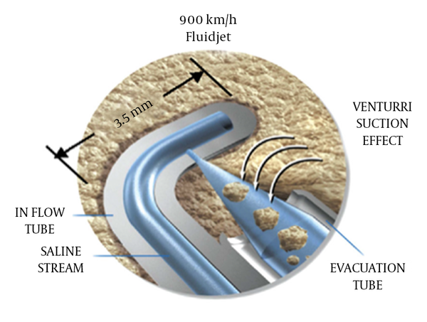 SpineJet Hydrosurgery System