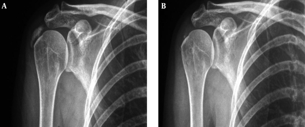 The calcification decreased from 24 mm to 3 mm. The pain measured by VAS also decreased from 10/10 to 5/10 (left image=before; right image=after).