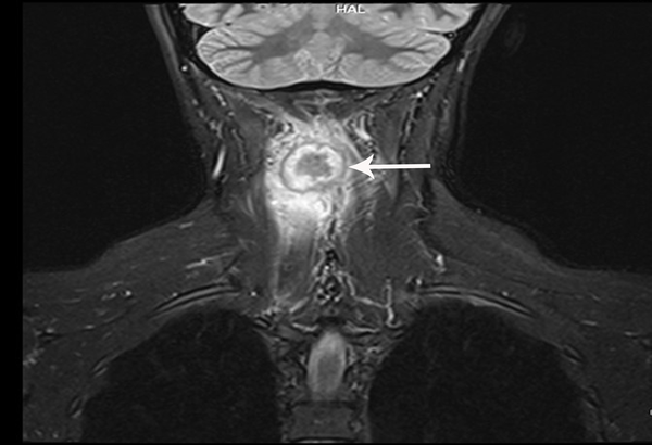 Coronal post contrast T1WI shows considerable enhancement of the peripheral thick rim and adjacent posterior soft tissues of the C3 and C4 vertebrae.