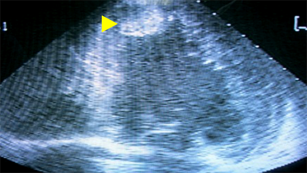 Patient 2. Echocardiography shows severe hypokinesia of the left