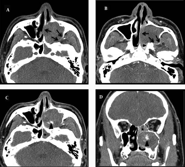 Enhanced CT of the paranasal sinuses shows a 4.3 × 2.8 × 4.3 sized heterogeneous enhanced soft tissue mass in the maxillary sinus, the central region of which was in particular strongly enhanced (arrow head). The expansion of the maxillary sinus and bony thinning of the posterior and medial wall of the left maxillary sinus are also noted (black arrows). A, nonenhanced axial section. B and C, enhanced axial sections. D, enhanced coronal section. Also, CT scans showed the opacification of the sphenoid and ethmoid sinuses because of the mass obstructing the draining sinus ostia (asterisk).