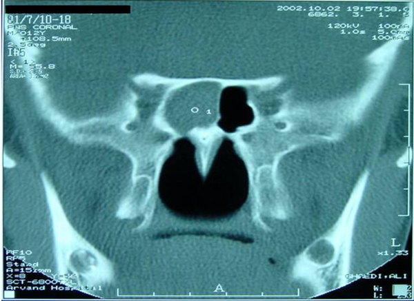 Mucocele located in the sphenoid sinus.
