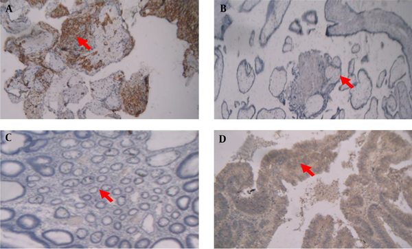 A, positive HLA-G staining in human placenta tissues; B, negative HLA-G staining in human placenta tissues; C, negative HLA-G staining in normal colorectal; D, positive HLA-G staining in colorectal cancer tissue.