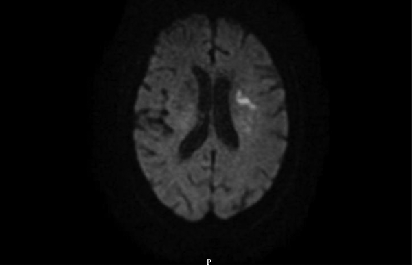 Brain MRI Diffusion Weighted Image Shows Diffusion Restriction in the Left Corona Radiata Consistent With Acute to Subacute Infarct