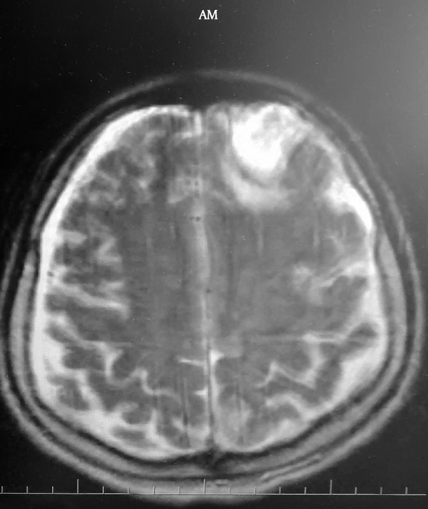 View of the Hyperintensity due to Chronic Hematoma of the Frontal Region in Transverse T1-Weighted Sequence