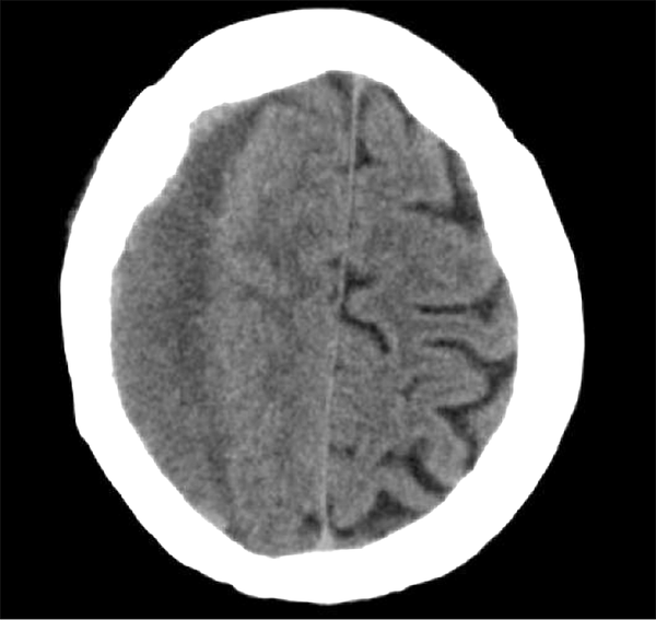CT Scan of Head Revealing Isodense to Hypodense Mass on the Right Side